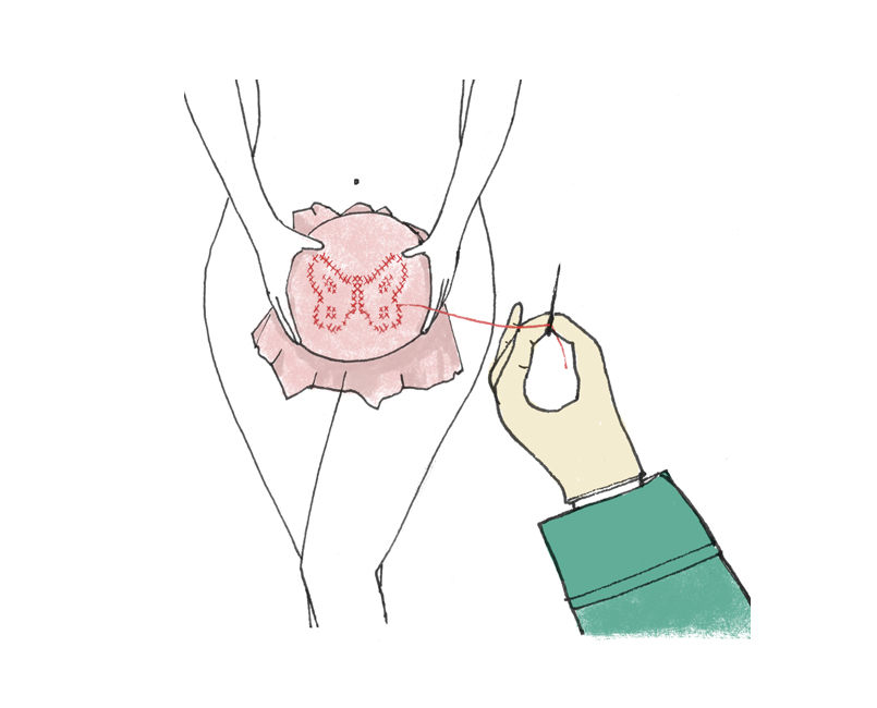 Cirugía vaginal